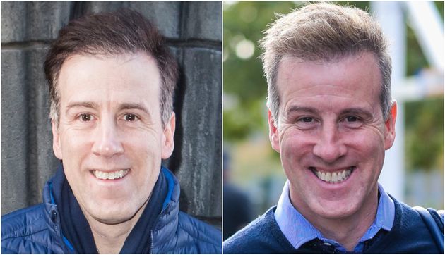 Anton Du Beke underwent a hair transplant in 2018